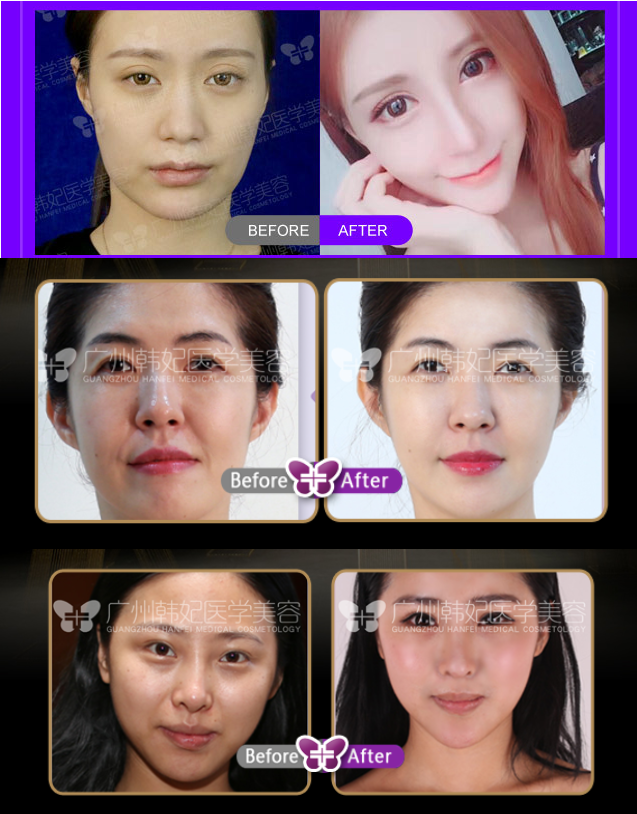 facial contouring